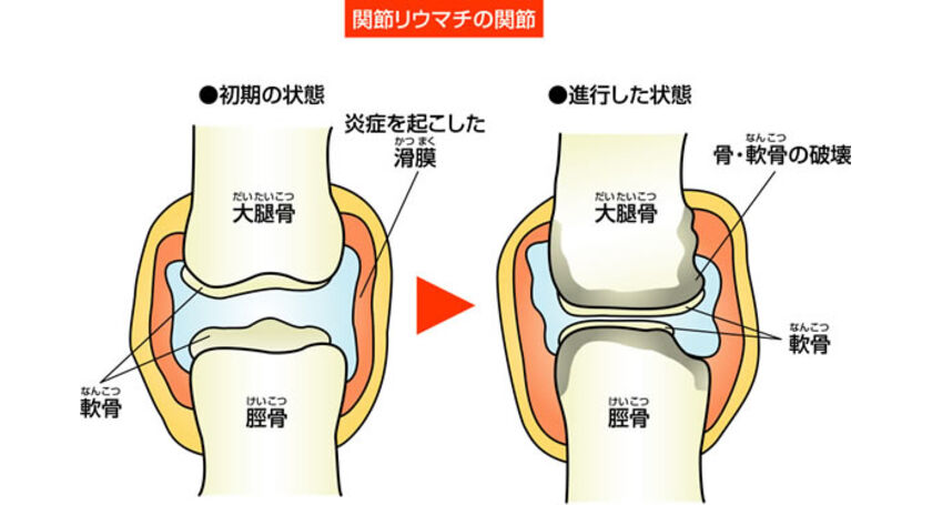 関節