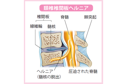 ヘルニア
