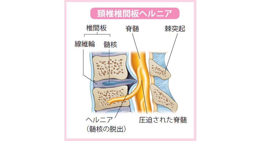 ヘルニア