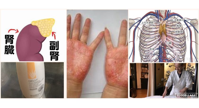 痛む酷い湿疹が短時間で アロエ95 以上のジェルの化粧水の半端ない実力 広尾の整体 天寿堂整復院のブログ
